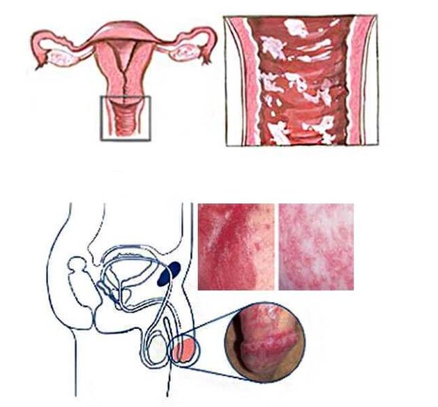 candidiasis of the female and male genital organs as a cause of pathological discharge