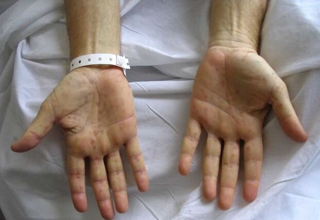 syphilis of the hands as a cause of pathological discharge from the penis